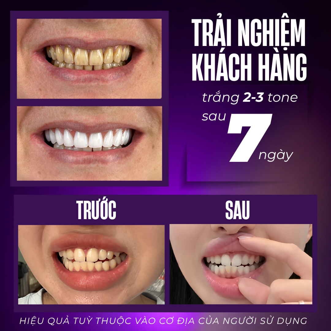 Hình ảnh so sánh trước và sau khi sử dụng V-Shine